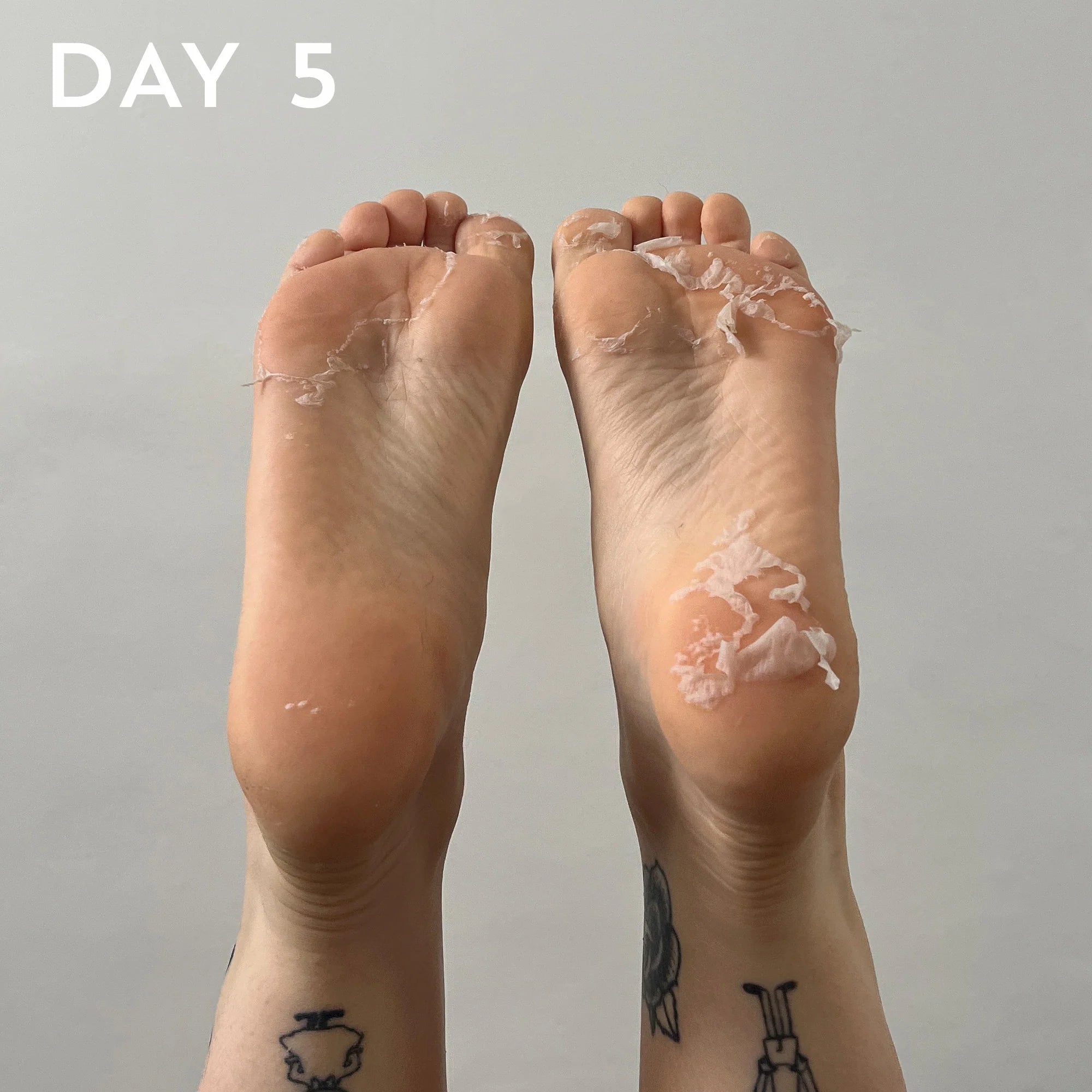 Two feet with peeling skin on a plain background, labeled 'Day 5'.