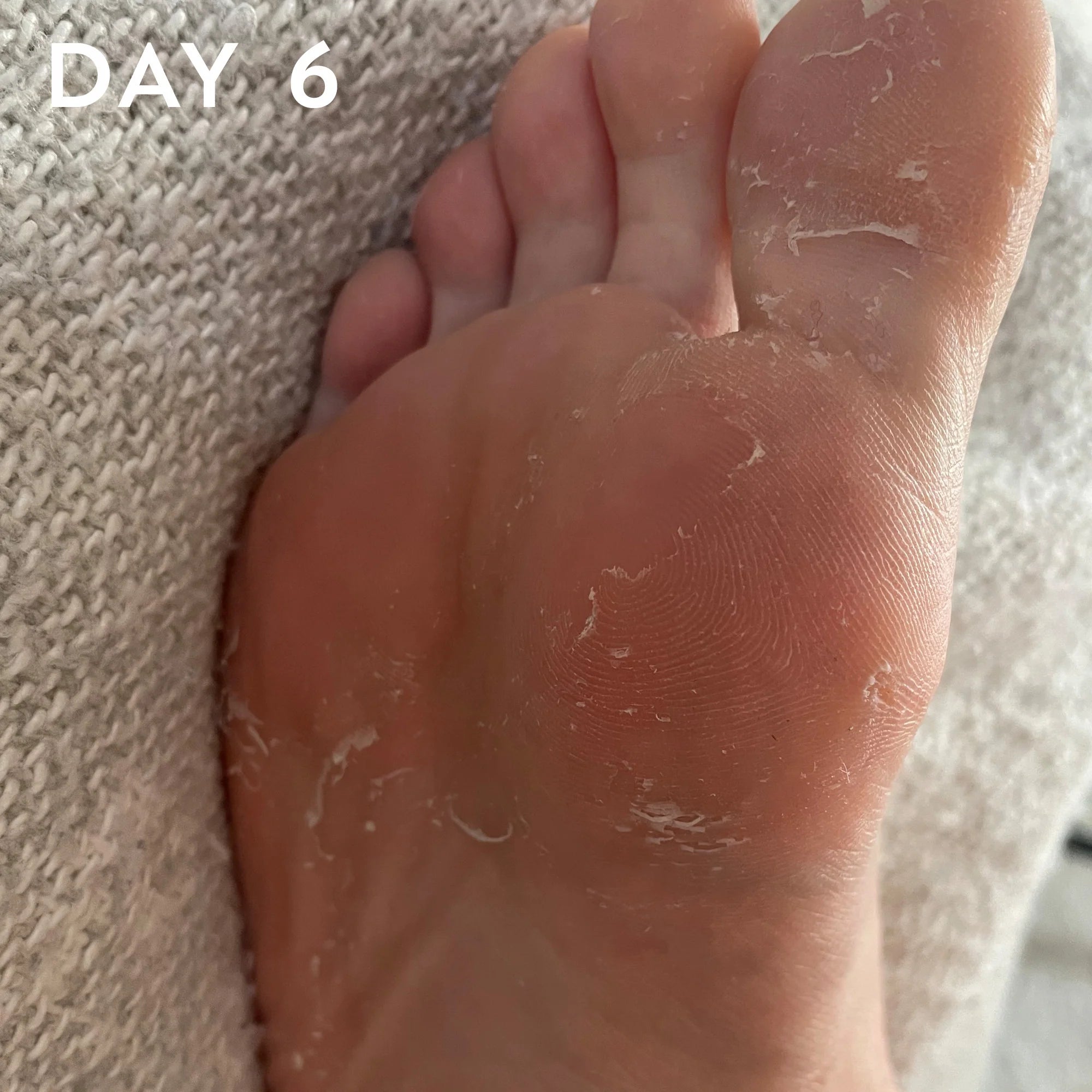 Professional Foot Peel Treatment Mask, 100% Plant Based Formula